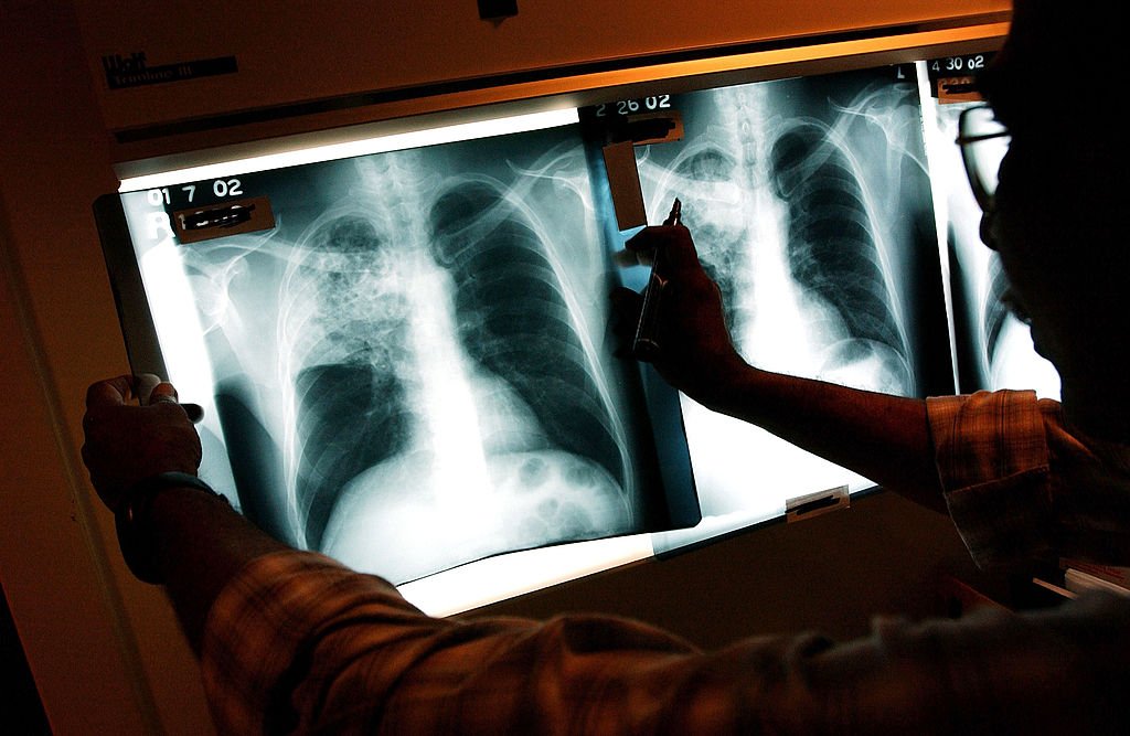 A doctor examines the X-rays of a patient in a file photo. (Spencer Platt/Getty Images)