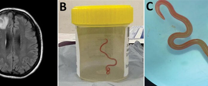 'Alive and Wriggling': 8 Centimetre Worm Extracted From Woman's Brain