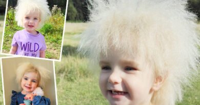 Girl With Frizzy Hair Nicknamed ‘Fluffy’ by Friends—She’s One of Only 100 People in the World With This Syndrome